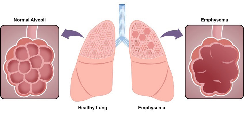 alveolar dead space in emphysema